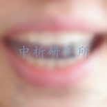牙貼檢測(cè)